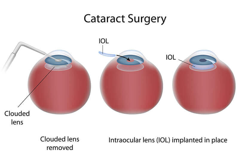 diagram of cataract surgery process