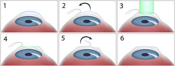 Chart Showing the Steps of LASIK